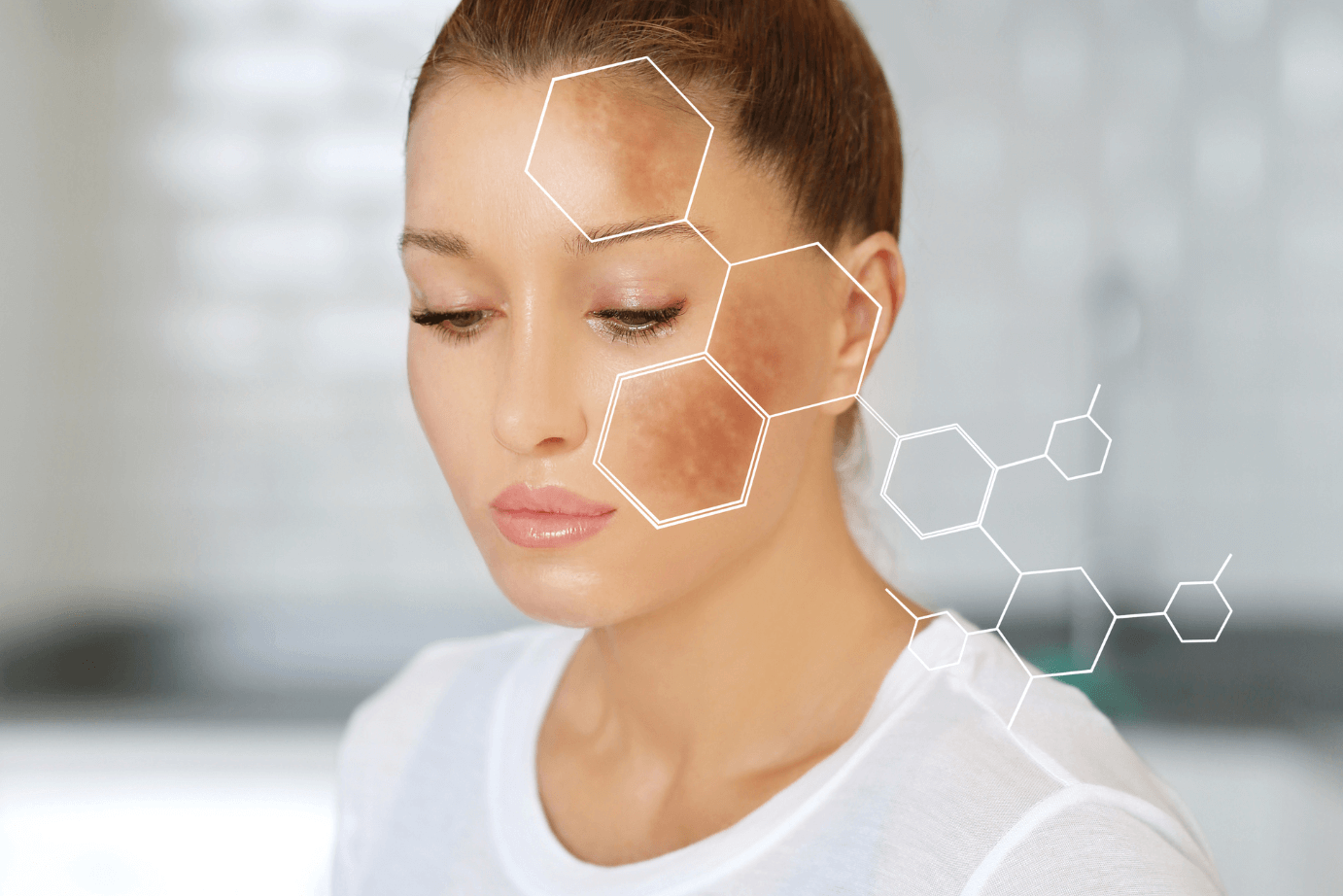 O Desafio do Melasma: Por que é hora de repensar as formas de controlar as manchas?