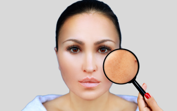 Controle do Melasma: saiba como combater e prevenir com compostos Bioativos